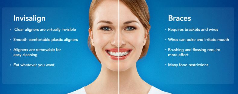 Invisalign - before and after patient