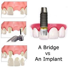 dental implants or dental bridge