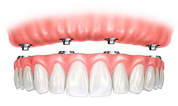 dental implant retained dentures